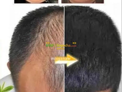 NEO HAIR LOTION 100% Original with delivery service  and derma roller - ኒዮ ፀጉር ሎሽን 100% ኦሪጅናል ከነጻ የማድረስ አገልግሎት ጋር እና ደርማ ሮለር
